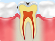 C1 【エナメル質のむし歯】
