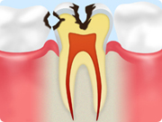C2 【象牙質のむし歯】