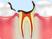 C4 【歯根まで達したむし歯】